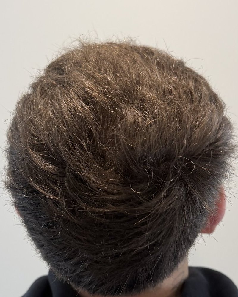 Crown 6 months after 2,200-graft FUE hair transplant at Gro Clinics