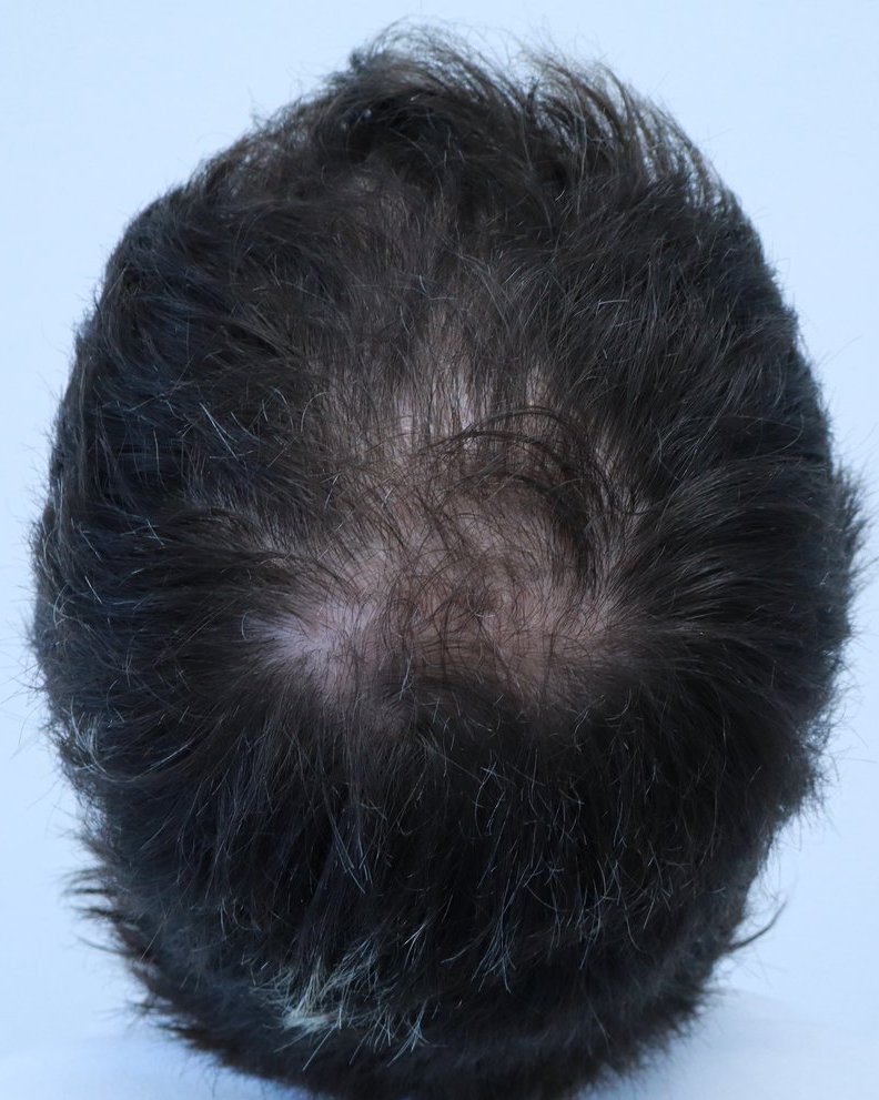 Crown thinning before FUE hair transplant