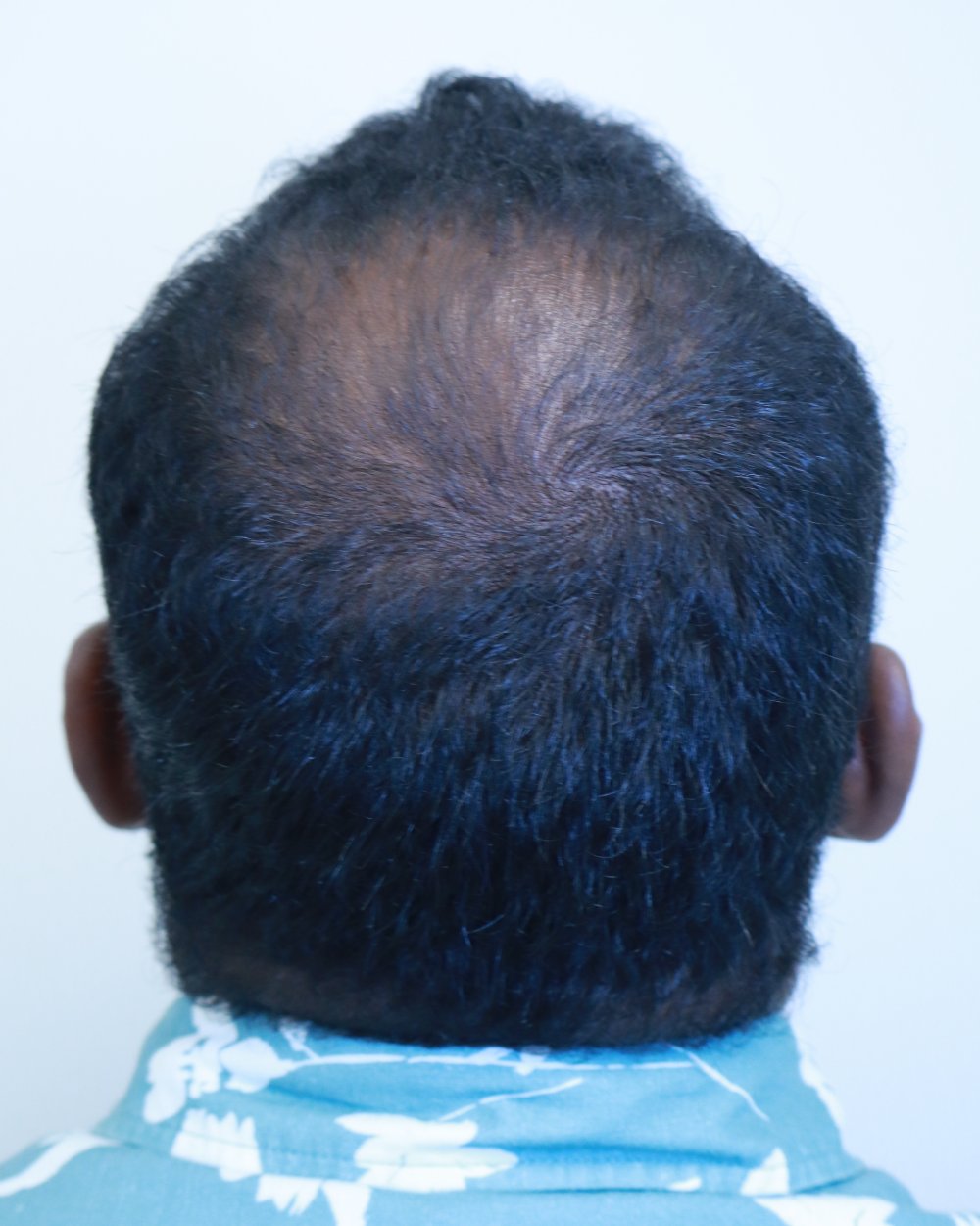 Pre-shave day of surgery