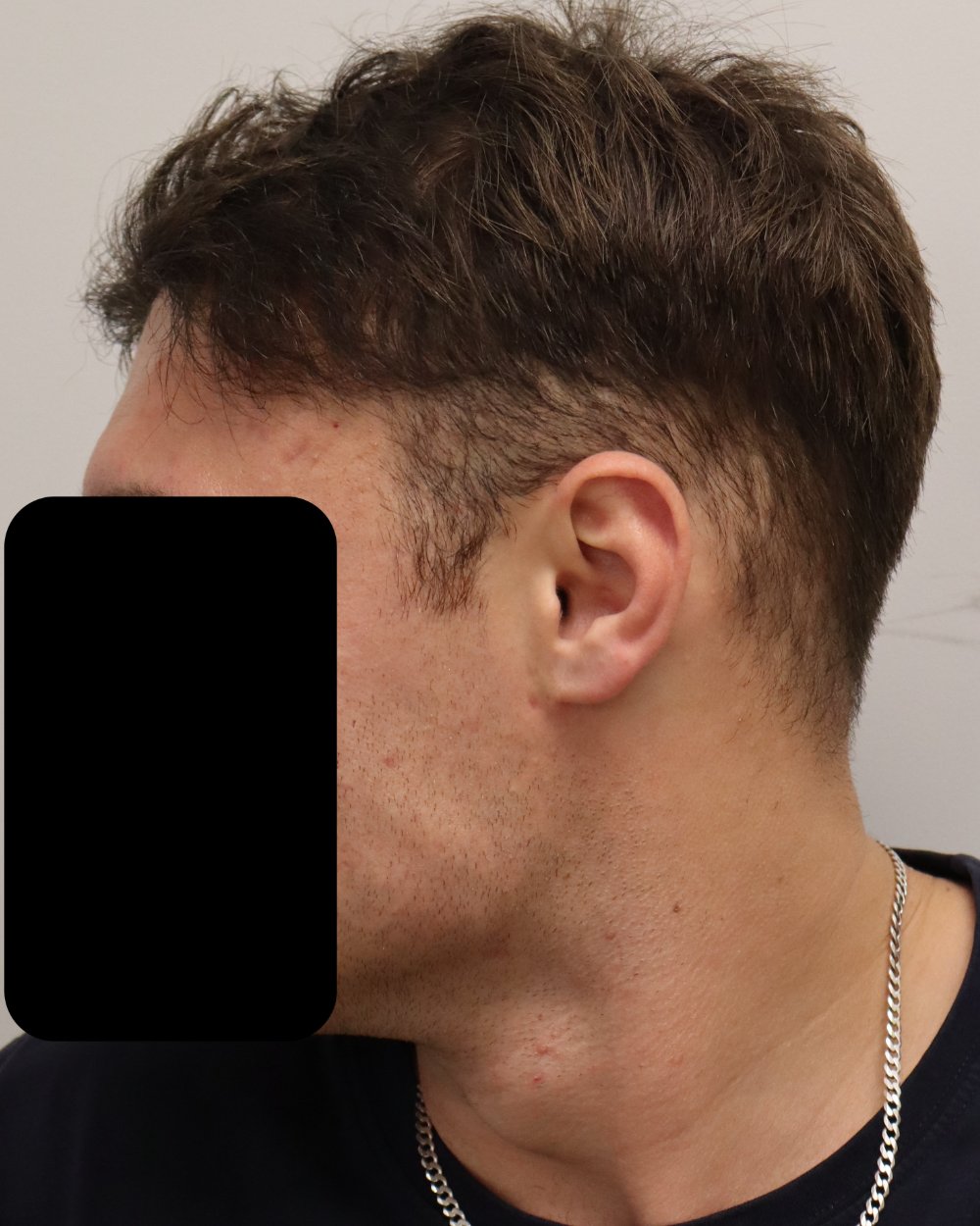 6 months post-op