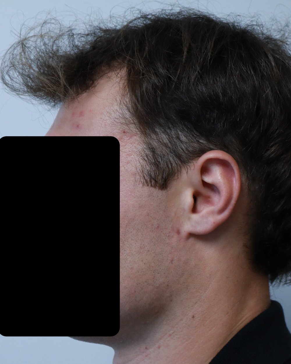 Example of temples receding a little, before surgery