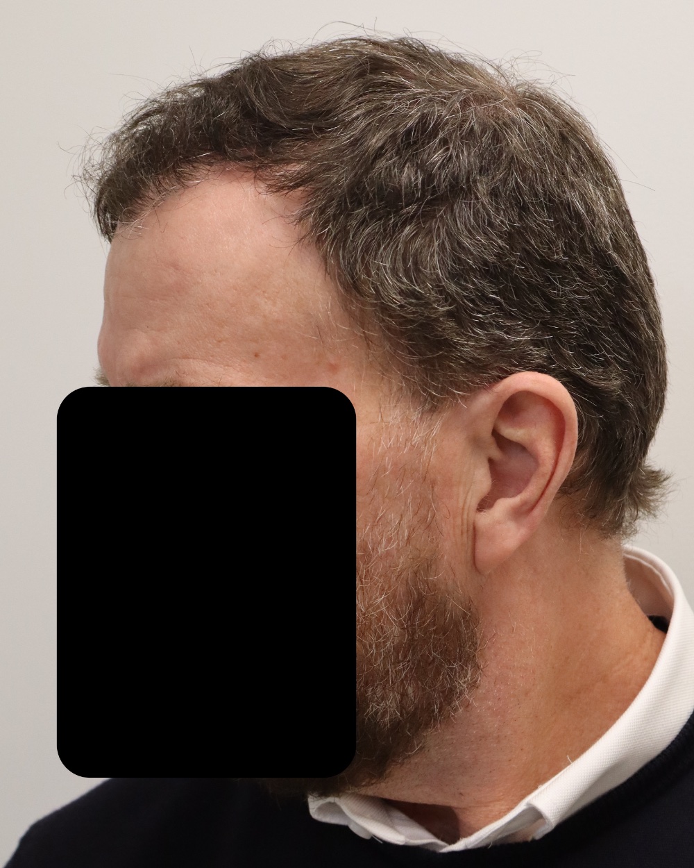 Frontotemporal hairline 6 months after 1,493-graft FUE hair transplant at Gro Clinics, Auckland