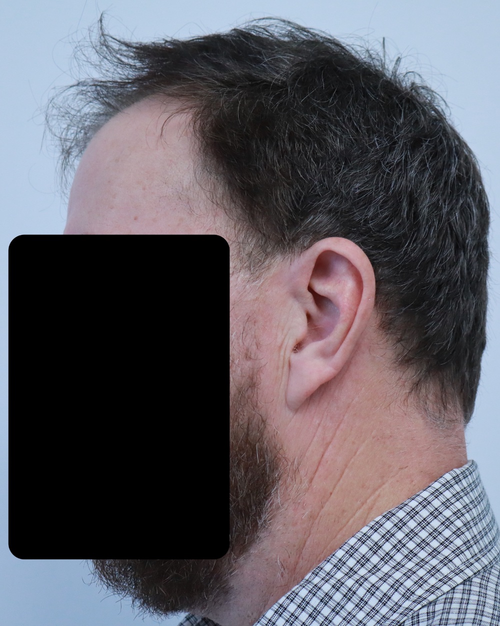 Frontotemporal recession before FUE hair transplant