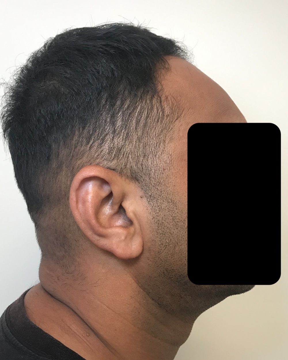 Pre-shave day of surgery