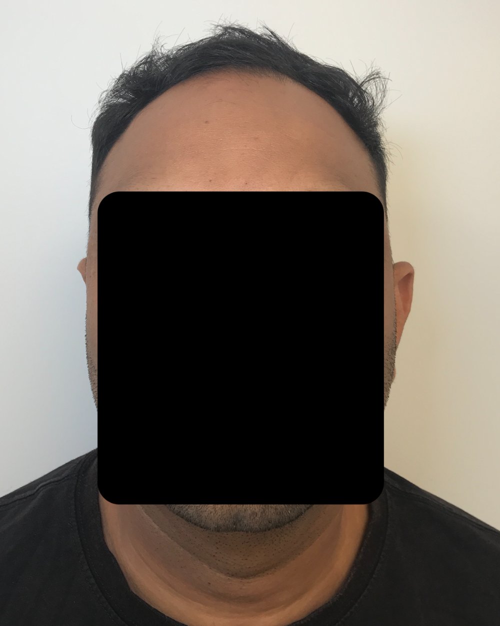 Pre-shave day of surgery