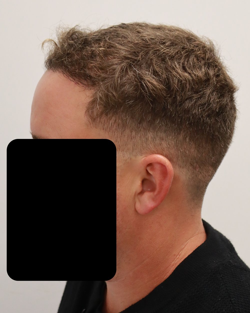 Frontotemporal hairline 6 months after 1,847-graft FUE hair transplant at Gro Clinics, Auckland