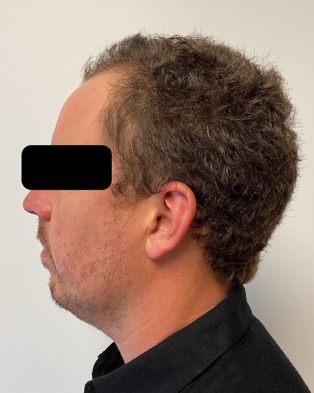 Frontotemporal recession before FUE hair transplant