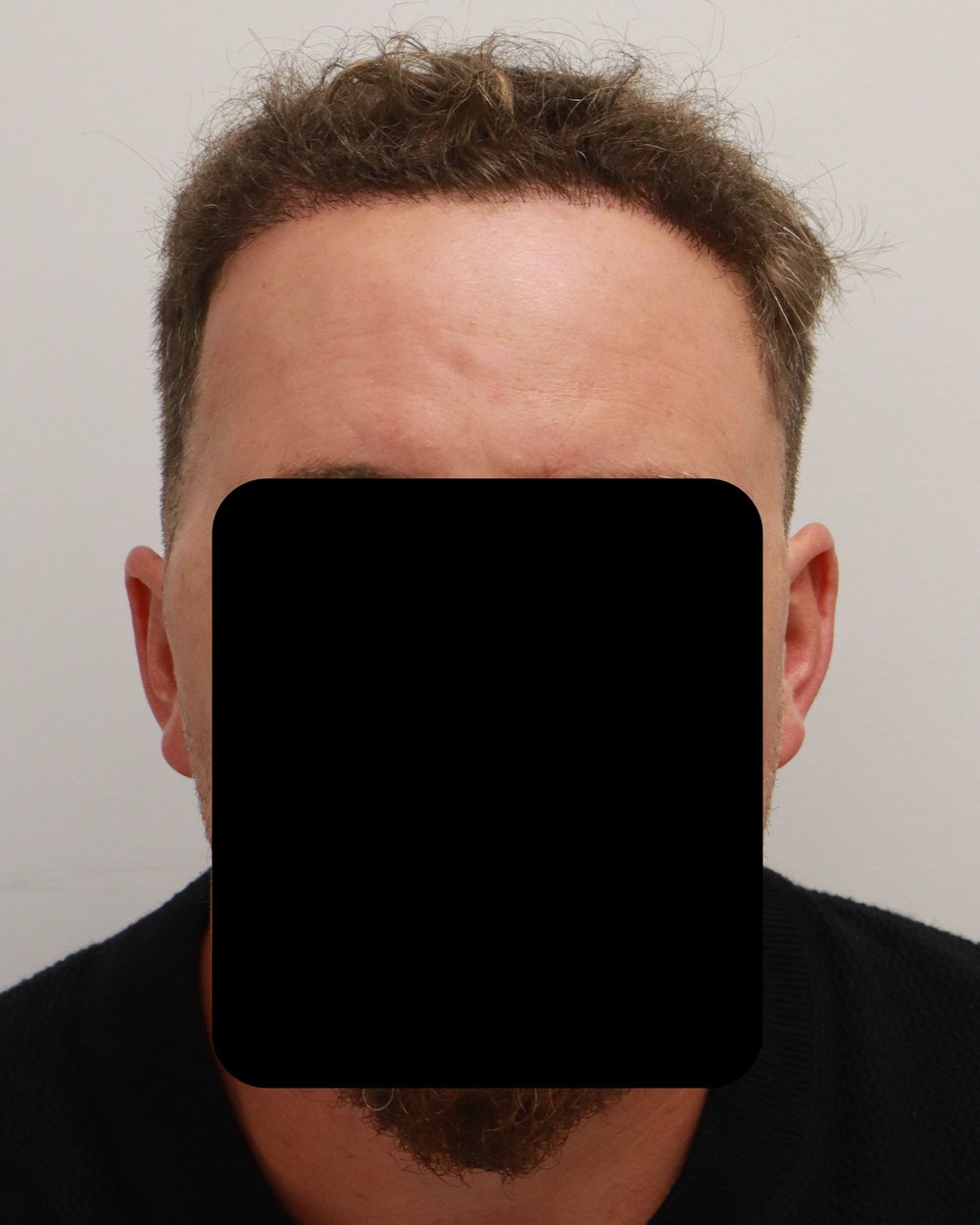 Frontotemporal hairline 6 months after 1,847-graft FUE hair transplant at Gro Clinics, Auckland