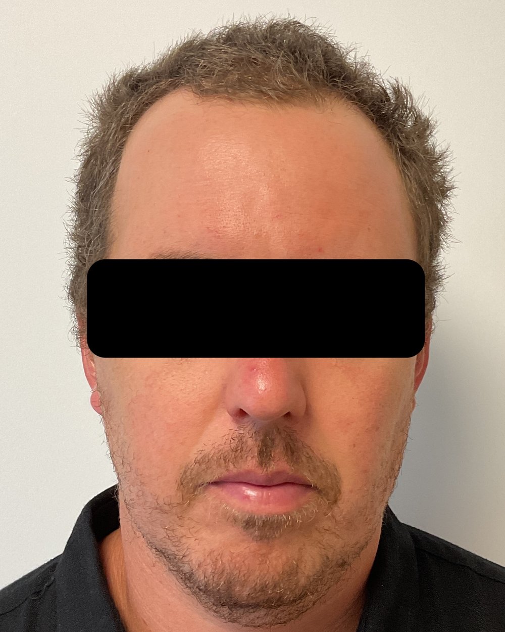 Frontotemporal recession before FUE hair transplant