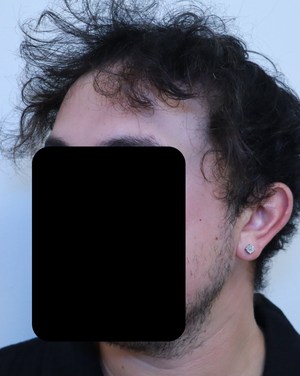 Pre-shave day of surgery