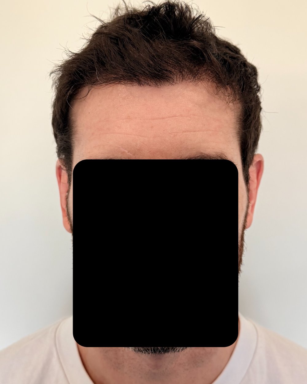 6 months post-op