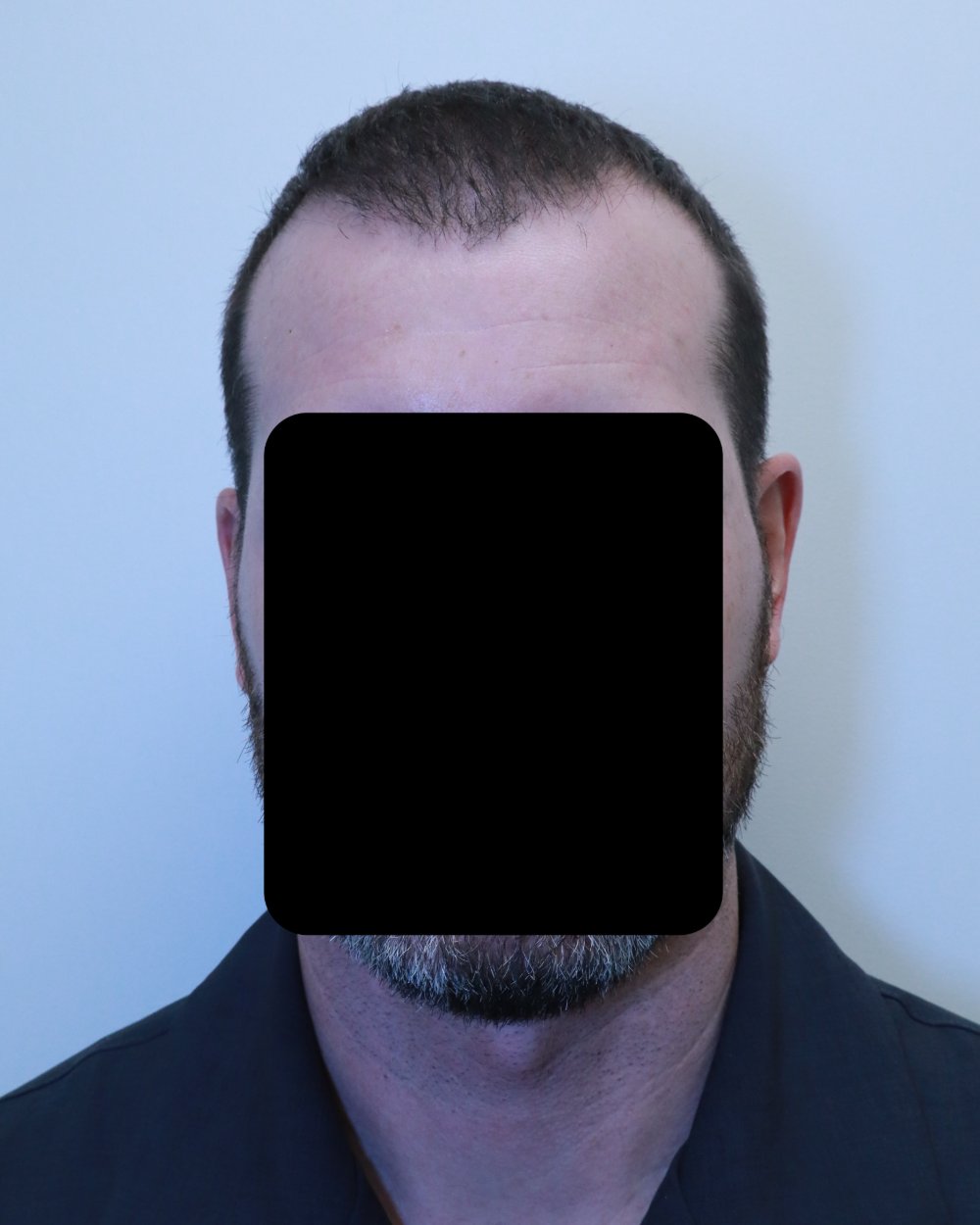 Pre-shave day of surgery