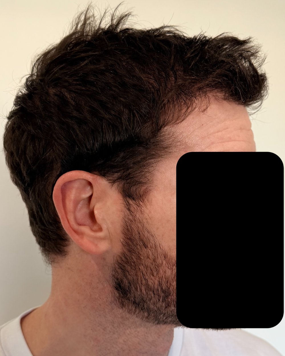 6 months post-op
