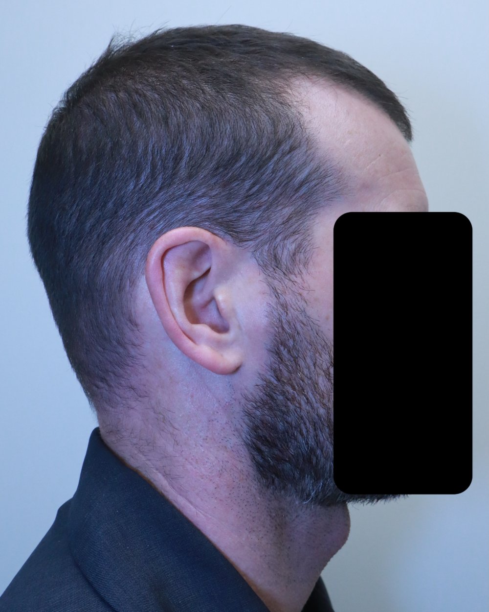 Pre-shave day of surgery