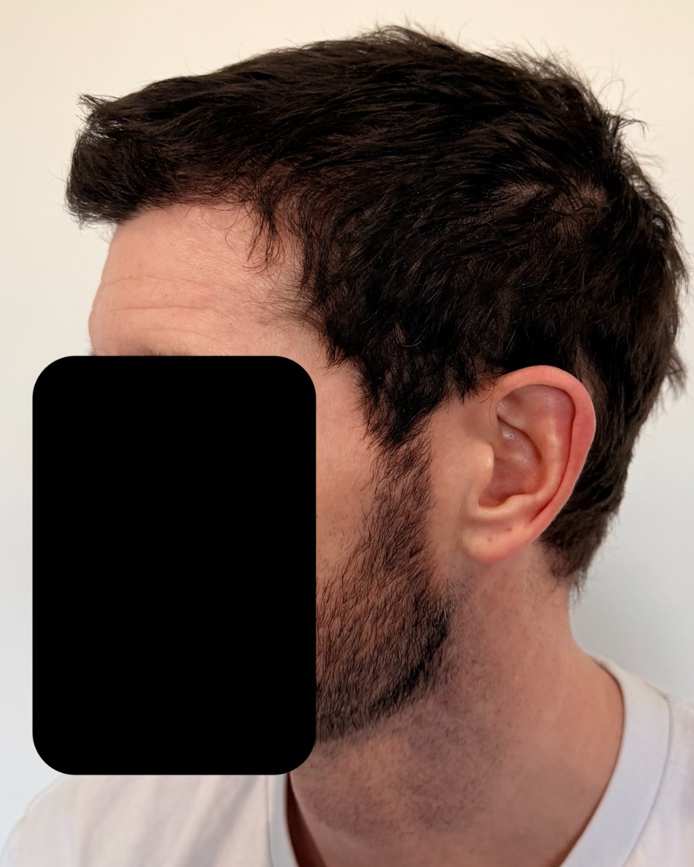 6 months post-op