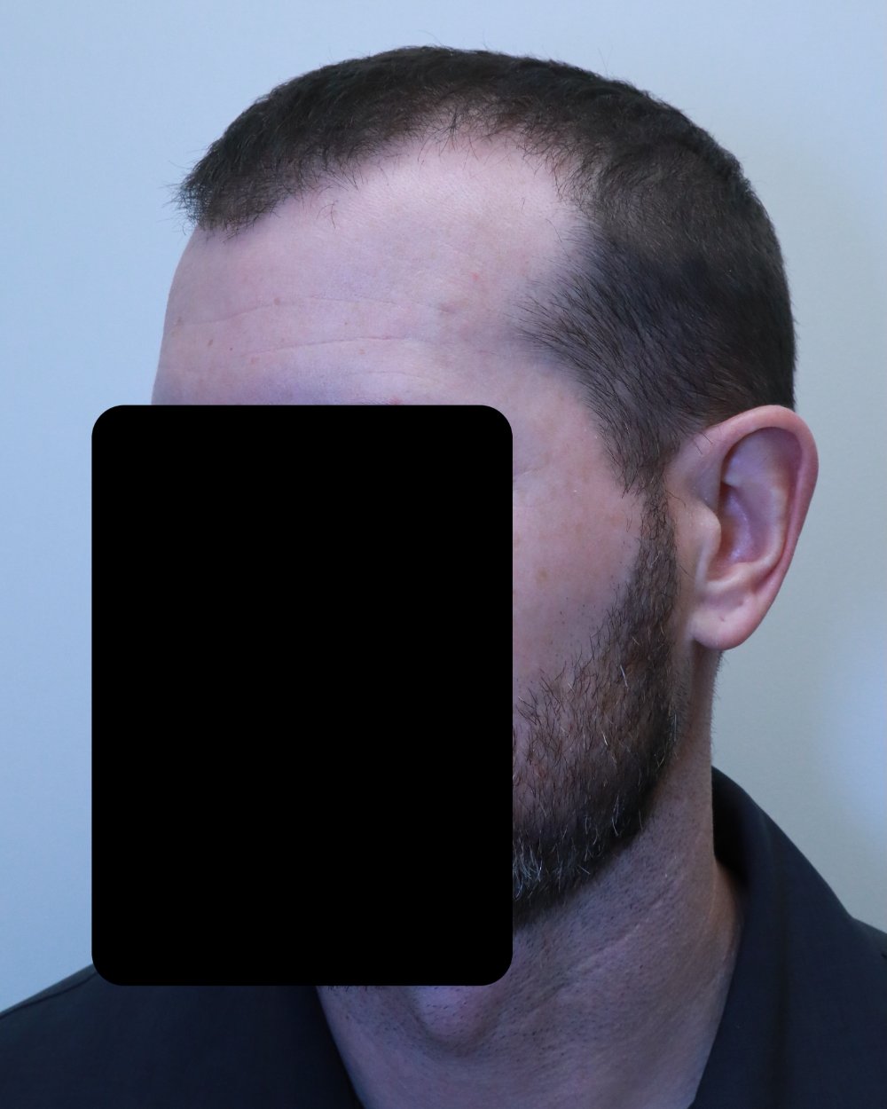 Pre-shave day of surgery