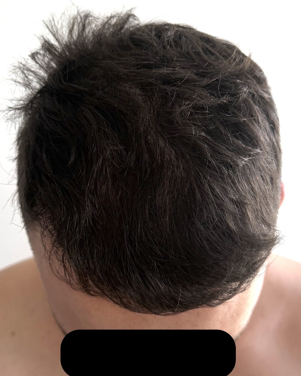 Frontotemporal hairline 6 months after 2,200-graft FUE hair transplant at Gro Clinics, Auckland