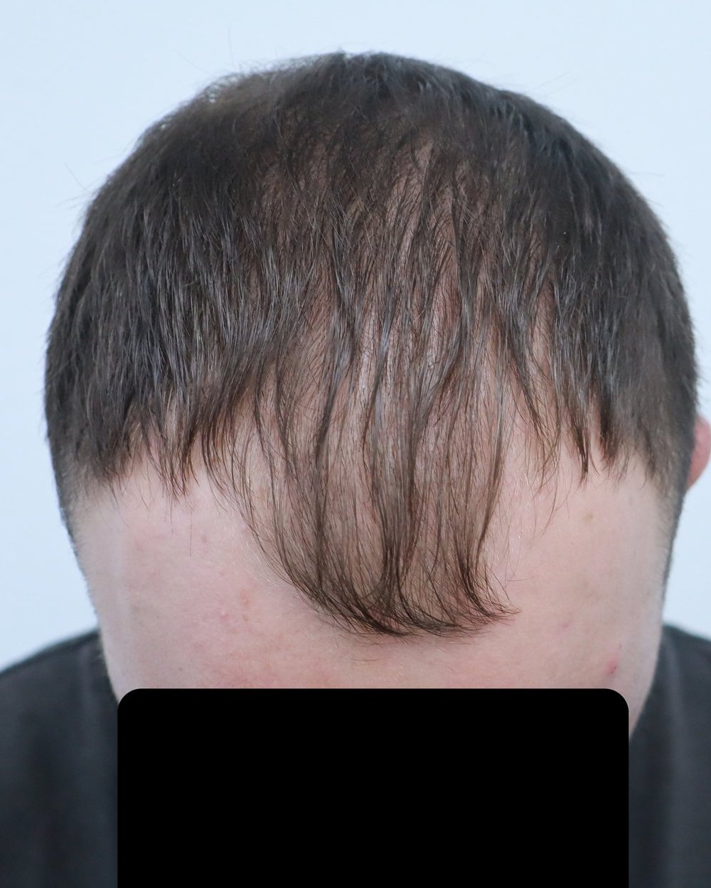Frontotemporal recession before FUE hair transplant