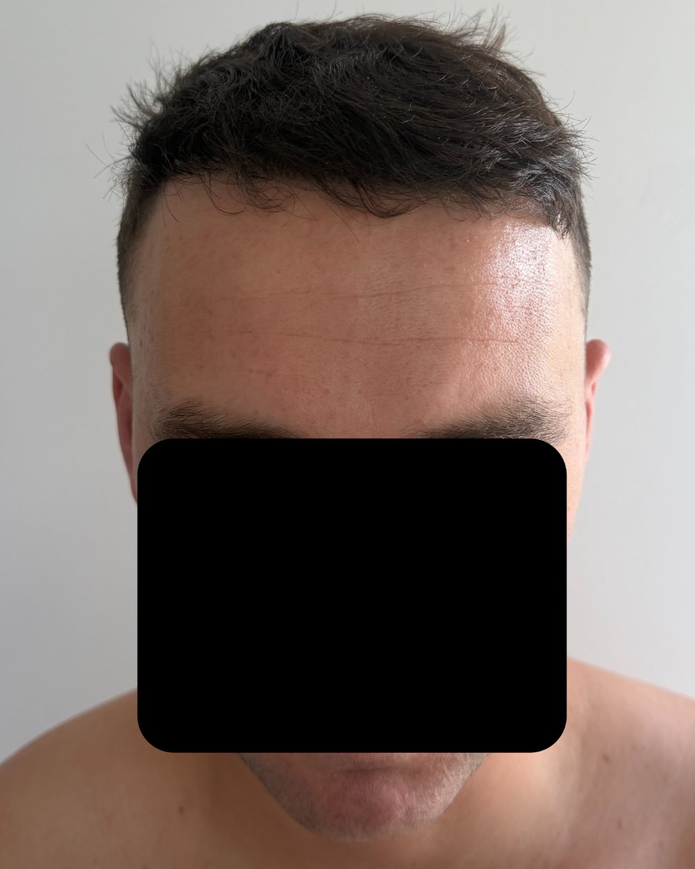 6 months post-op
