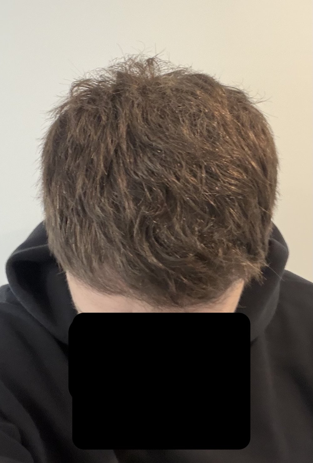 Frontal hairline 6 months after 2,200-graft FUE hair transplant at Gro Clinics
