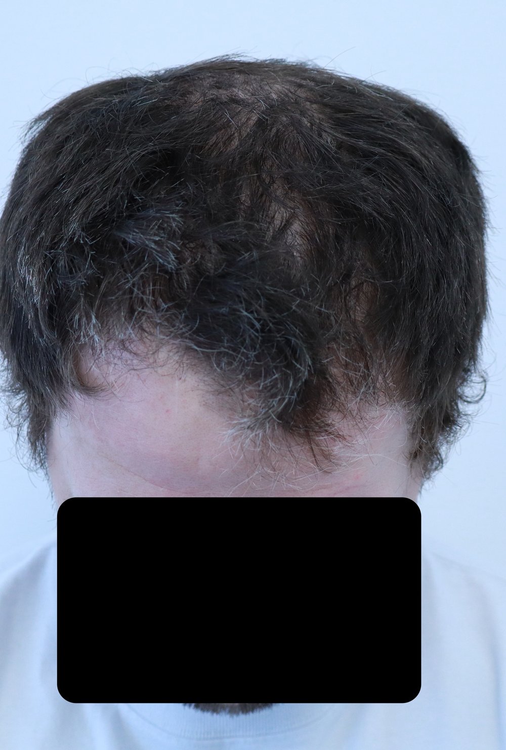 Frontal hairline and mid-scalp thinning before FUE hair transplant