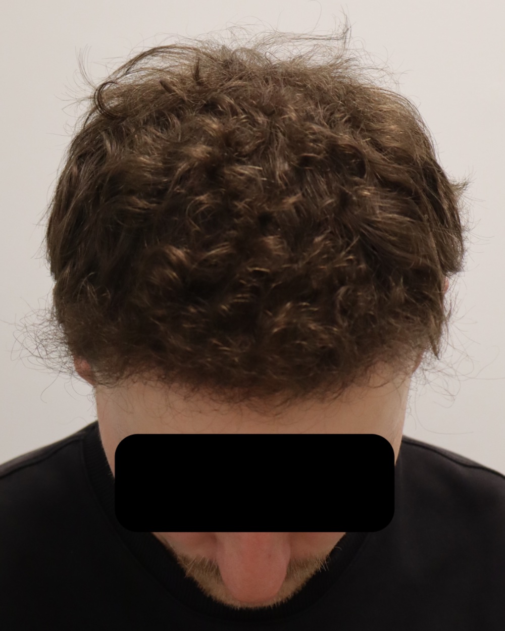 Frontotemporal hairline 6 months after 2,372-graft FUE hair transplant at Gro Clinics, Auckland