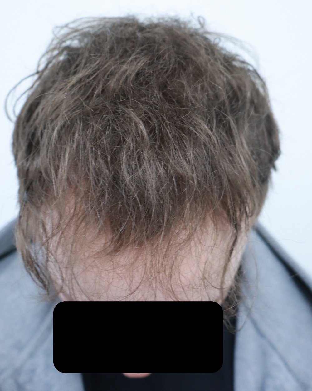 Frontotemporal recession before FUE hair transplant