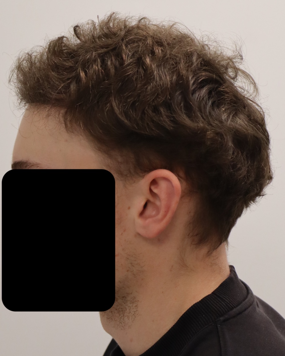 Frontotemporal hairline 6 months after 2,372-graft FUE hair transplant at Gro Clinics, Auckland