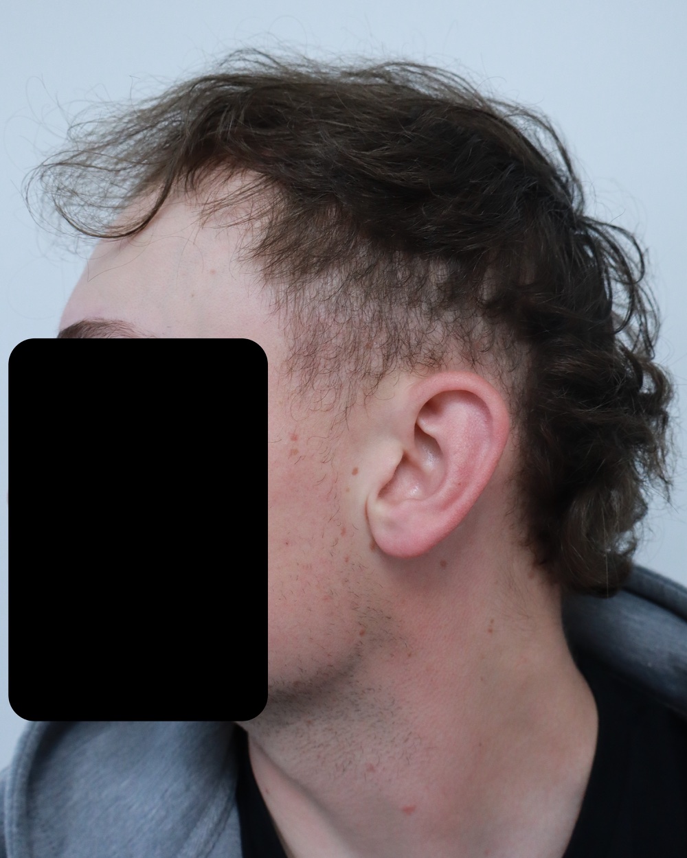 Frontotemporal recession before FUE hair transplant