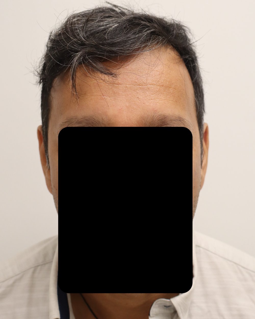 Frontotemporal recession before FUE hair transplant