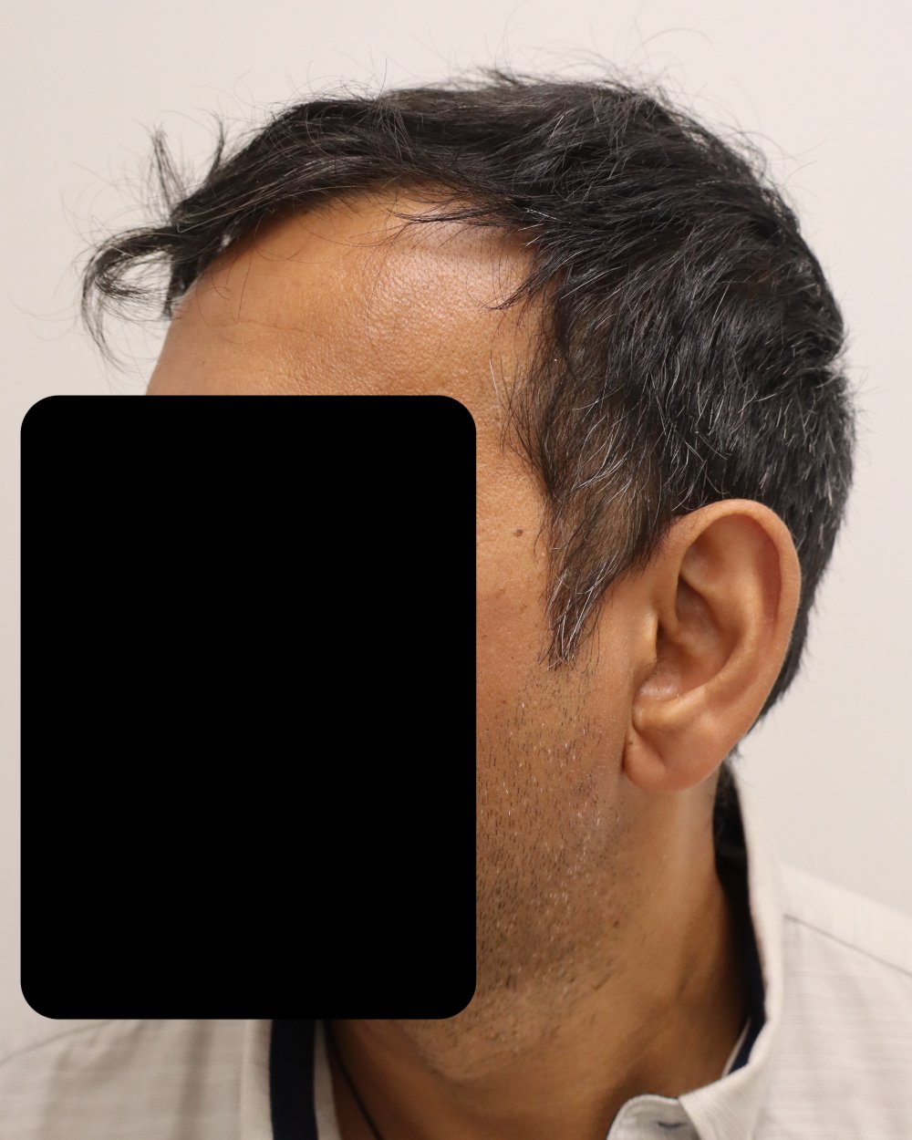 Frontotemporal recession before FUE hair transplant