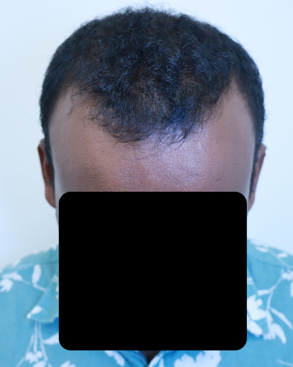 Pre-shave day of surgery