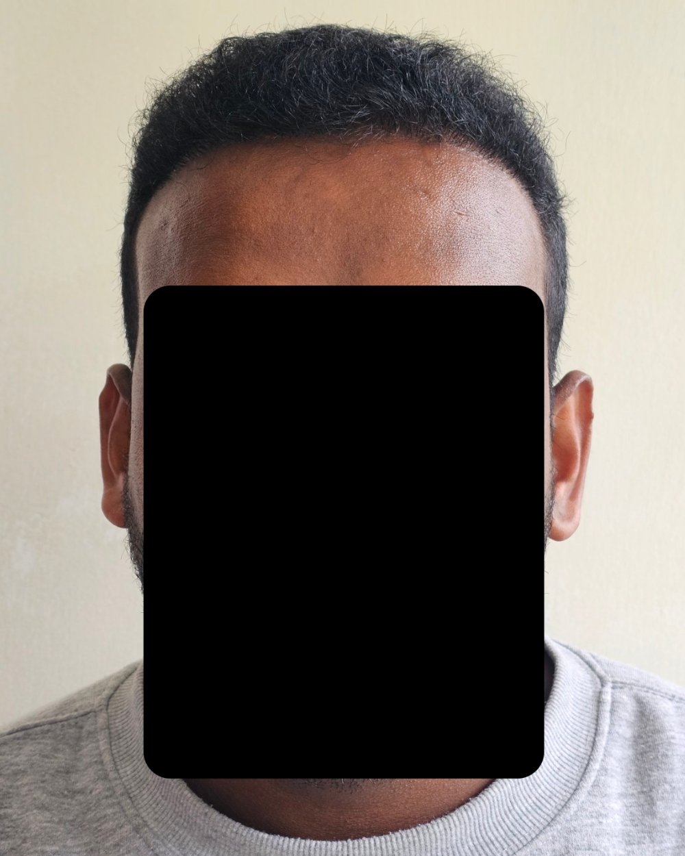 6 months post-op