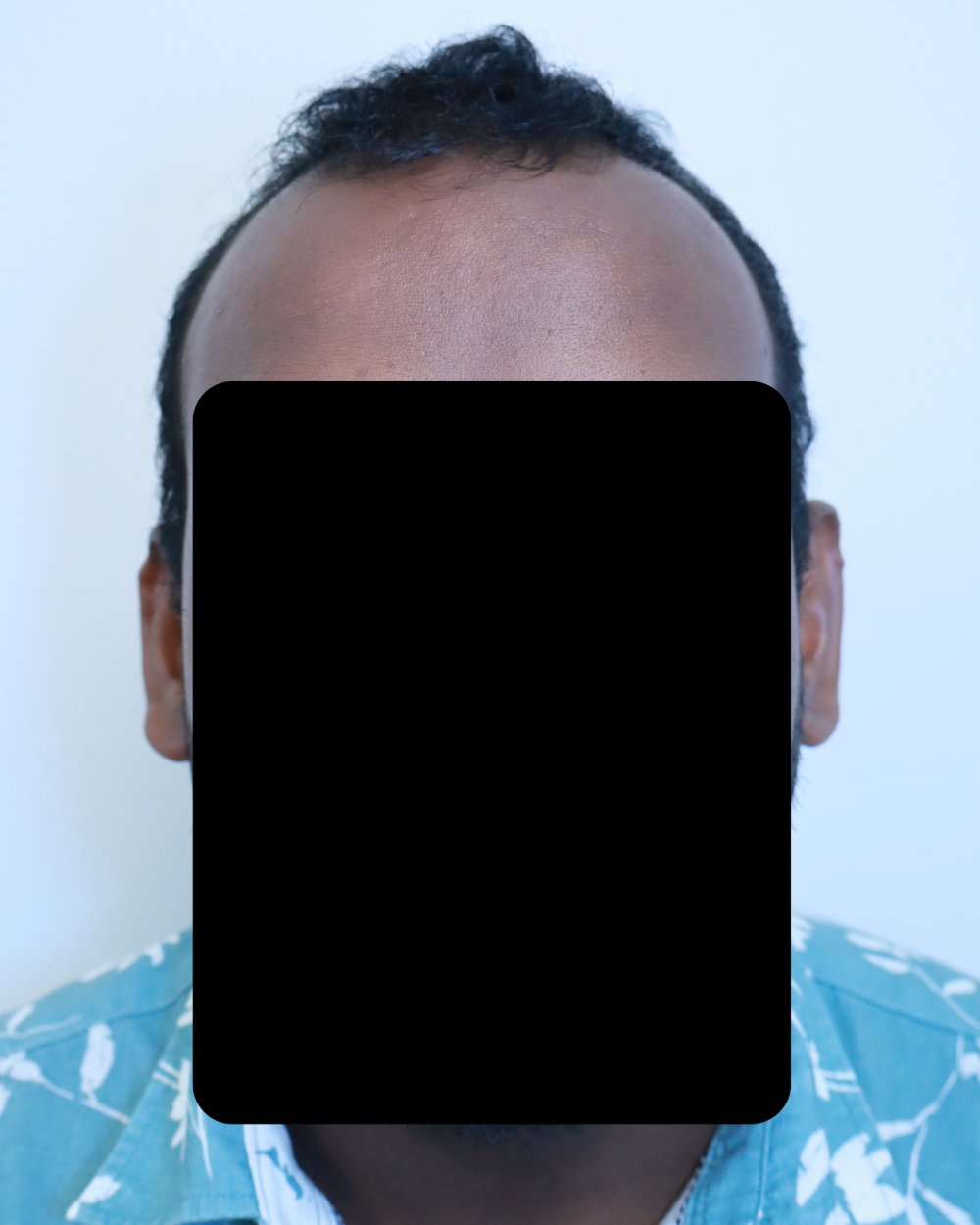Pre-shave day of surgery