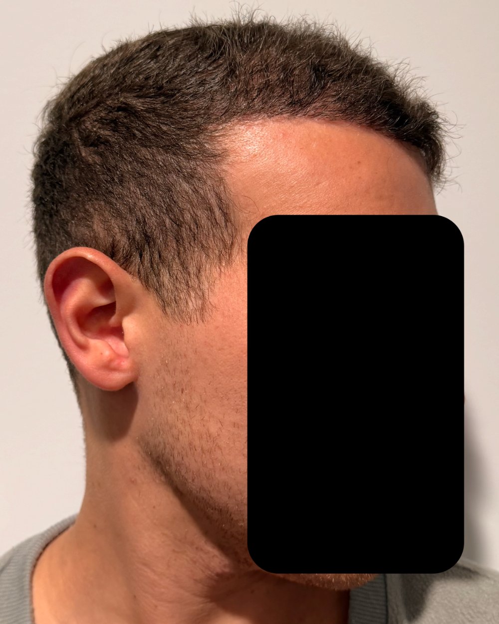 6 months post-op