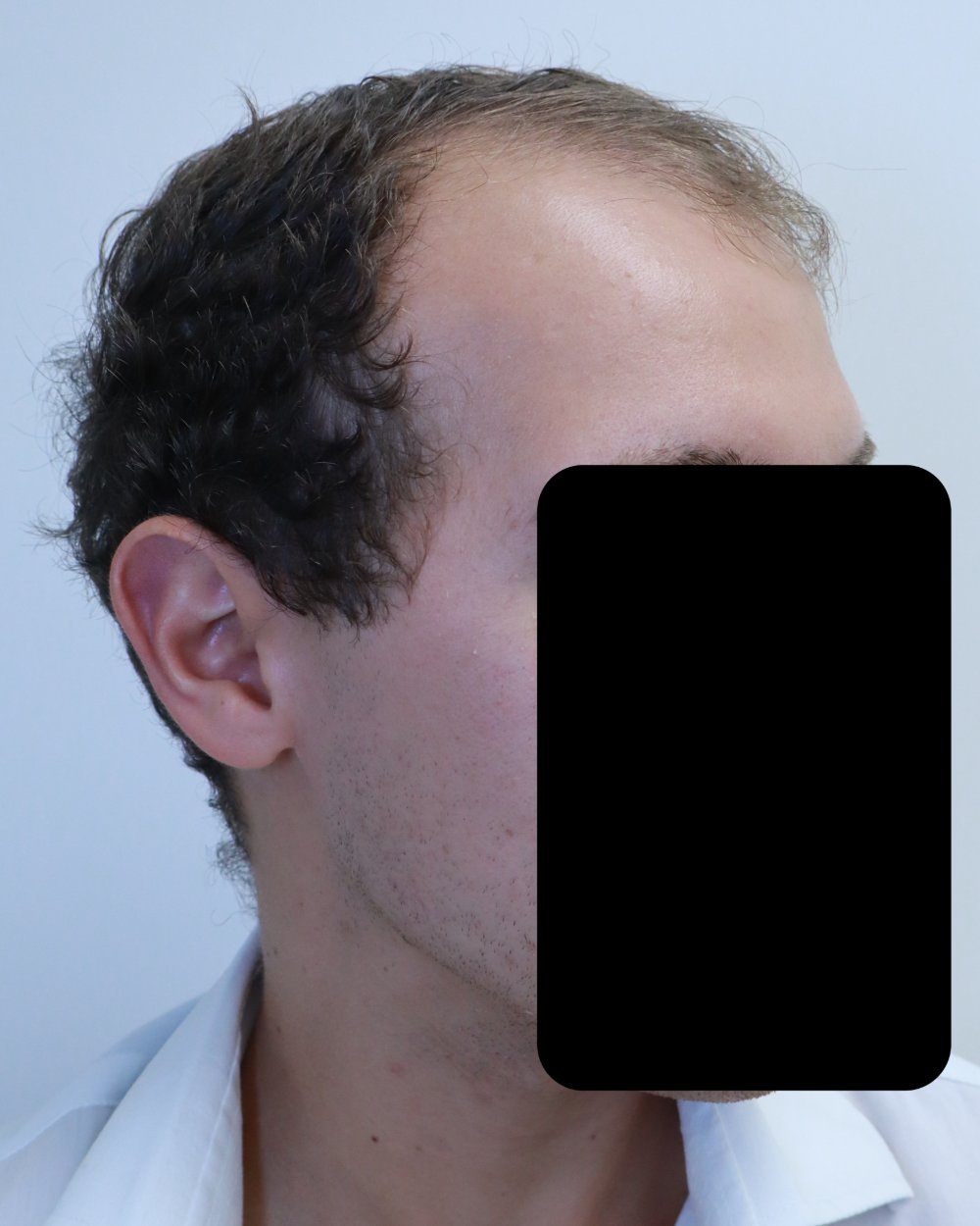 Pre-shave day of surgery