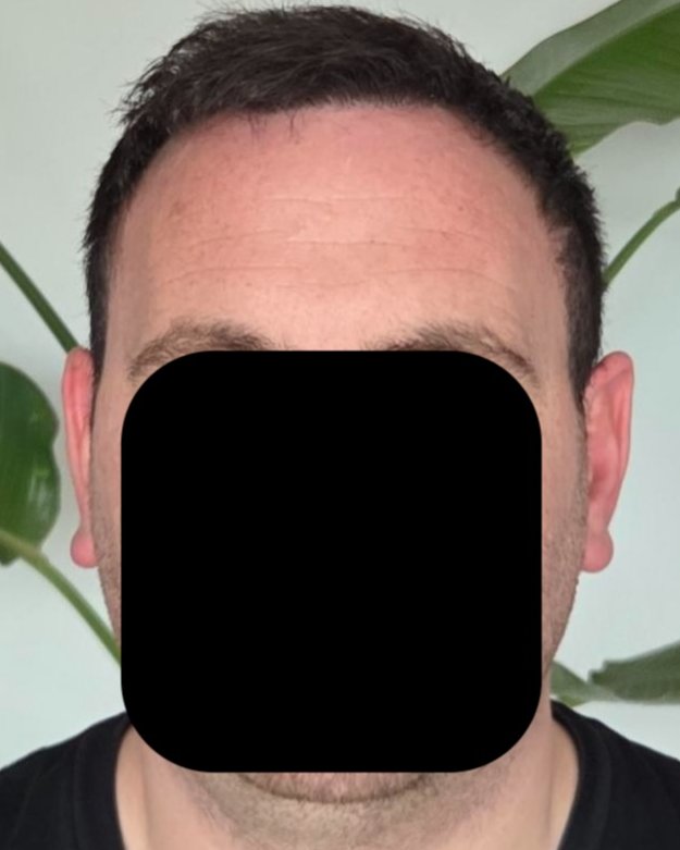 6 months post-op