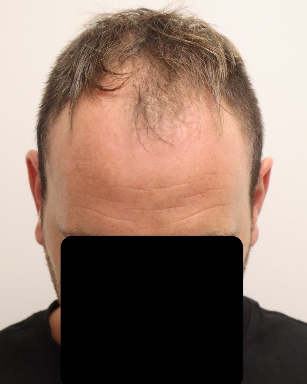 Pre-shave day of surgery
