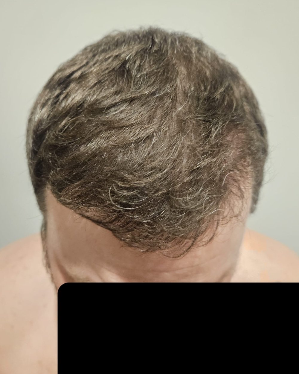 Frontotemporal hairline 7 months after 3,073-graft FUE hair transplant at Gro Clinics, Auckland