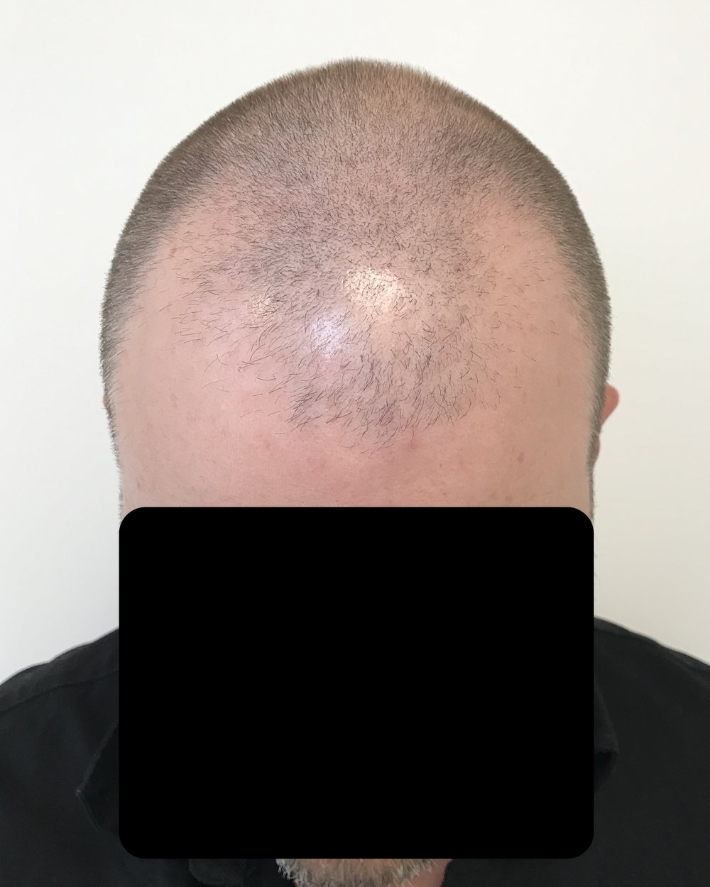 Frontotemporal recession before FUE hair transplant