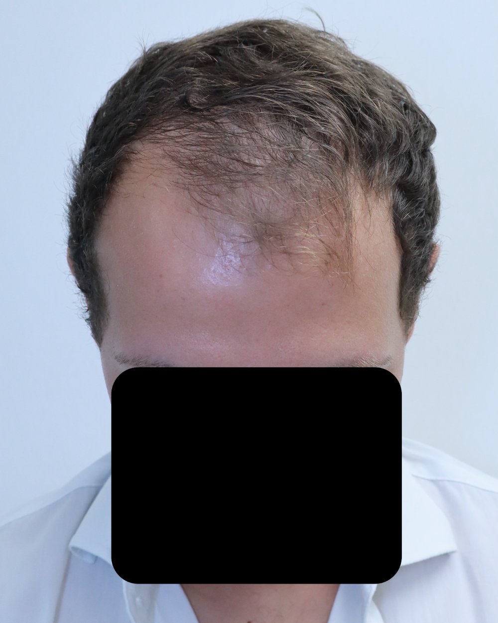 Frontotemporal recession before FUE hair transplant