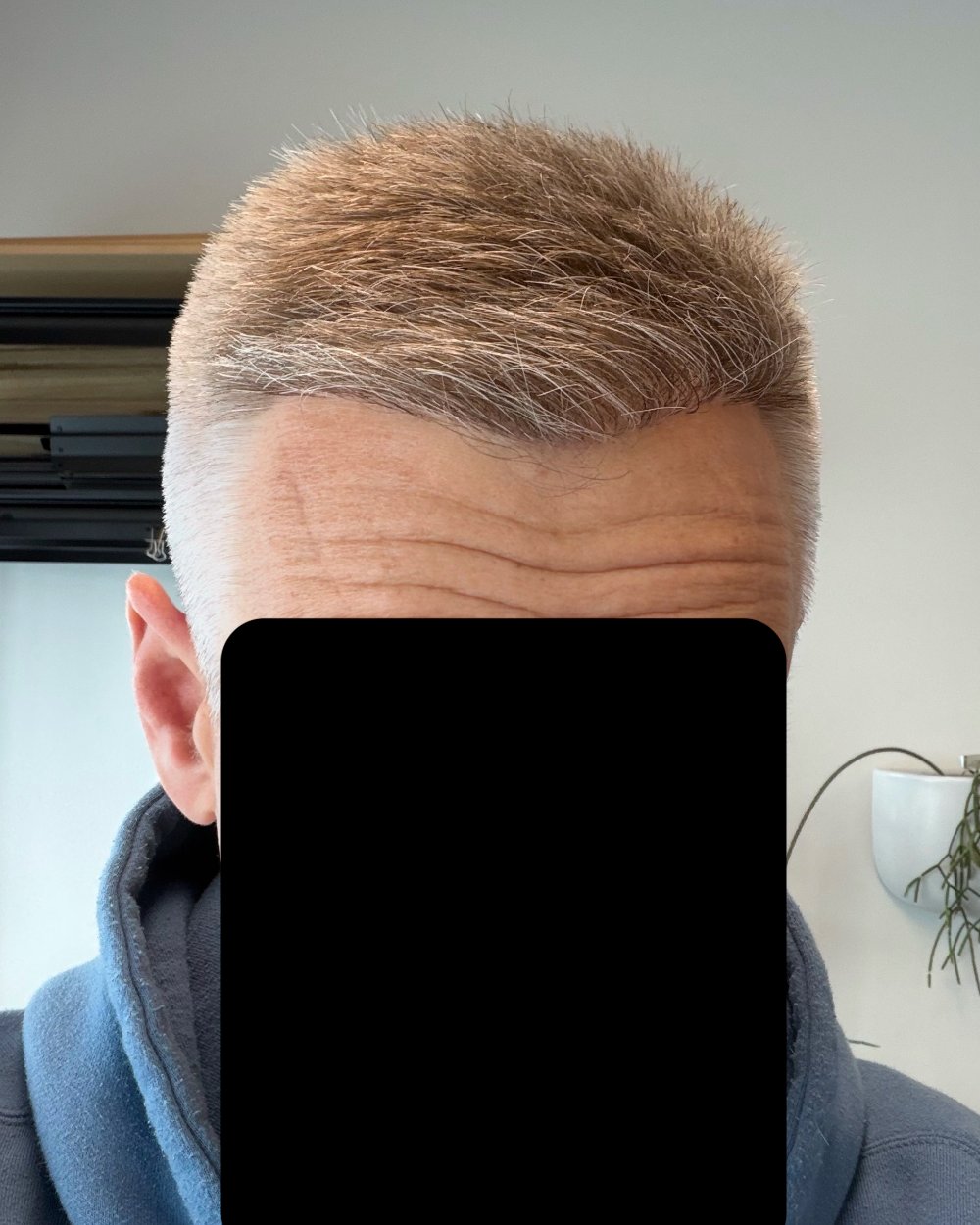 9 months post-op