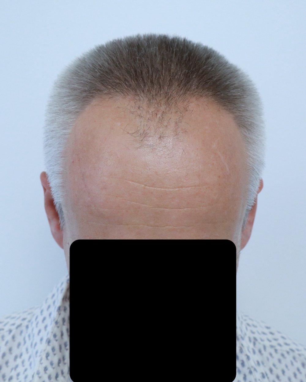 Frontotemporal recession before FUE hair transplant