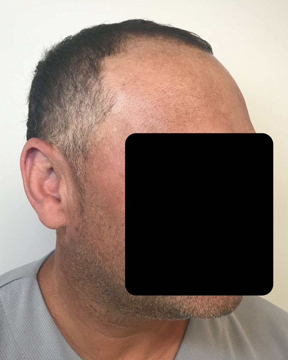 Pre-shave day of surgery
