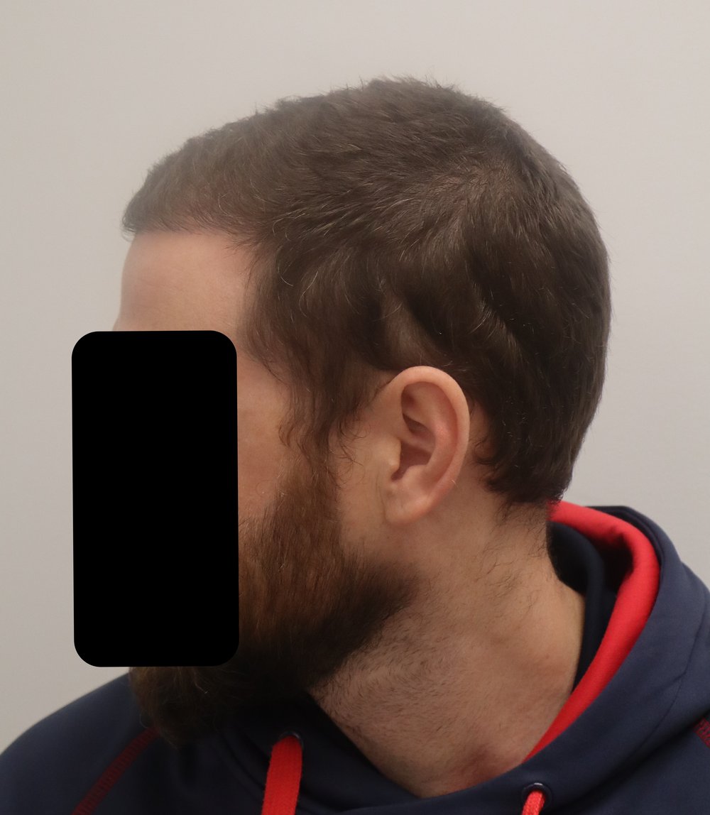 Frontotemporal hairline, side profile, 6 months after 2,100-graft FUE hair transplant at Gro Clinics