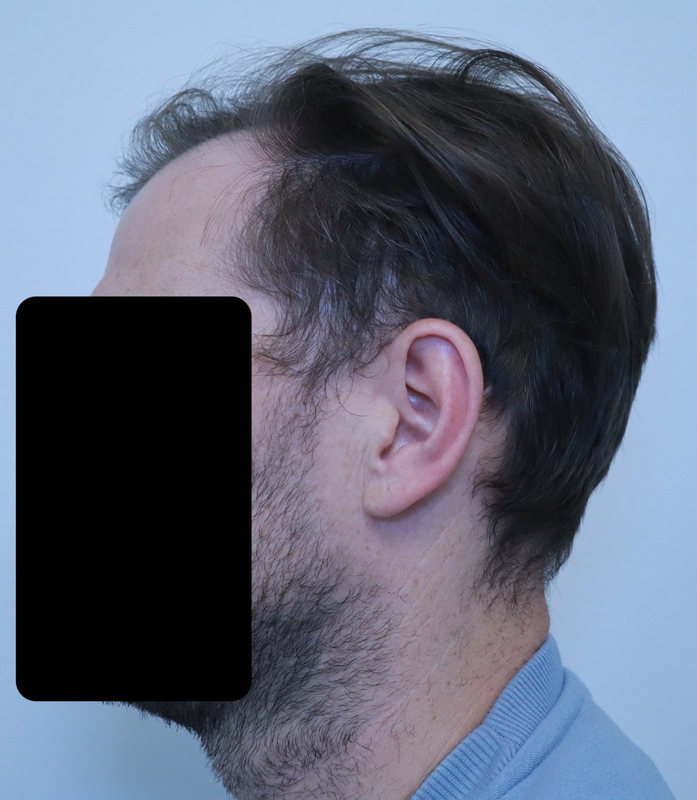 Frontotemporal recession, side profile, before FUE hair transplant