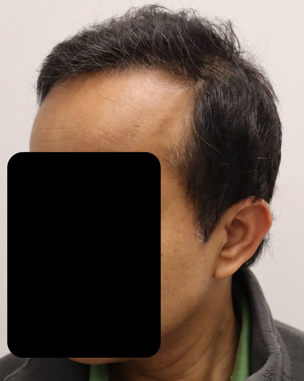 Frontotemporal hairline, side profile, 6 months after 3,600-graft FUE hair transplant at Gro Clinics