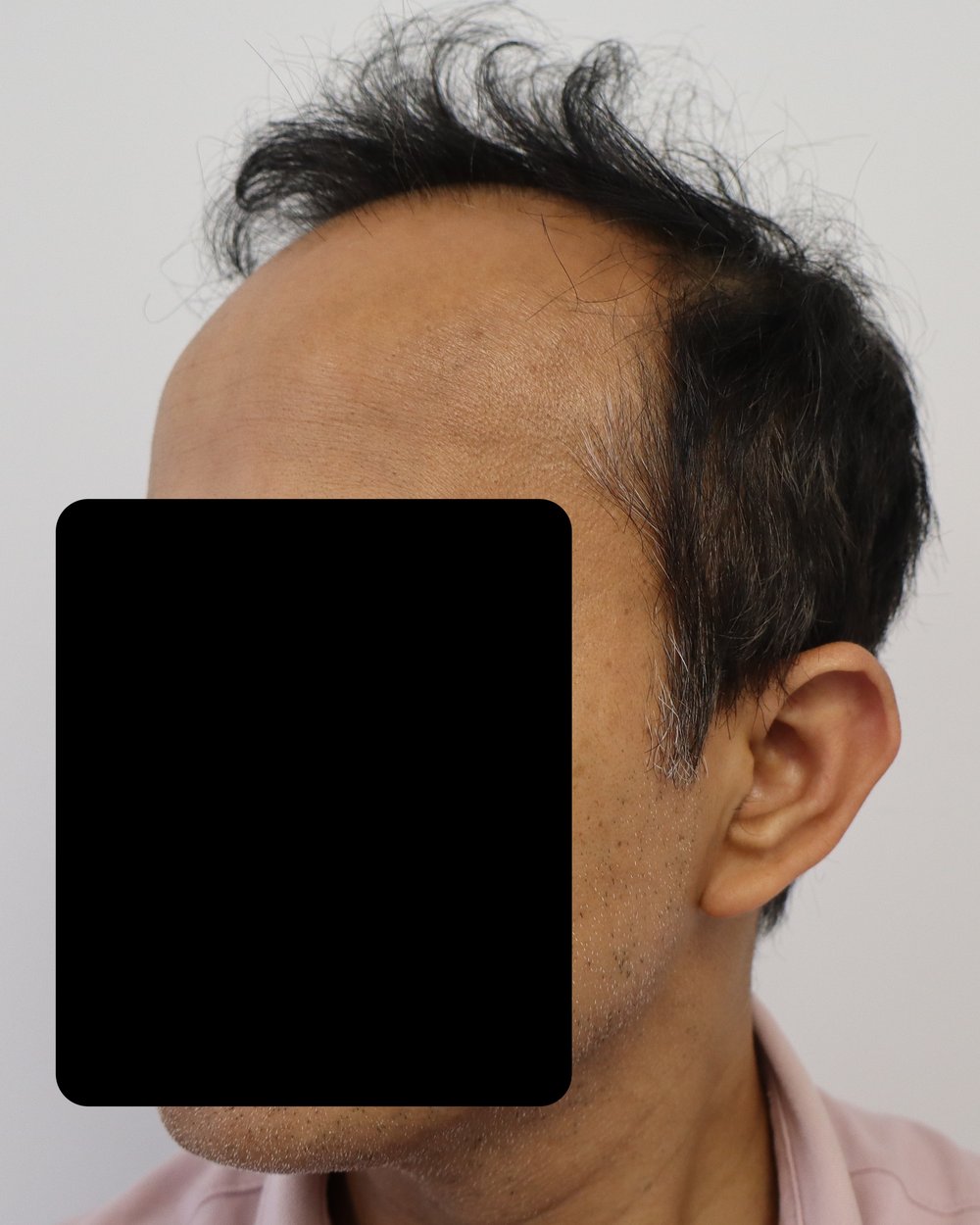 Frontotemporal recession, side profile, before FUE hair transplant