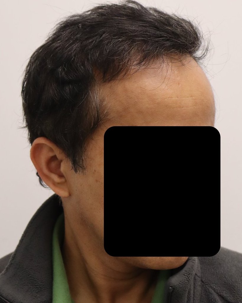 Full restoration 6 months after 3,680-graft FUE hair transplant at Gro Clinics, Auckland