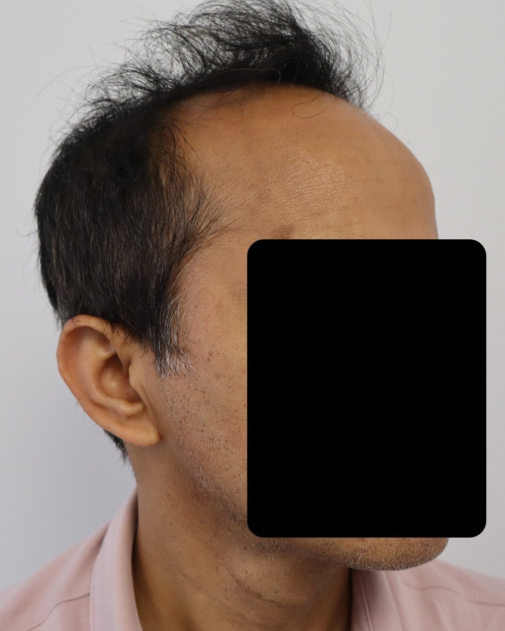 Advanced pattern hair loss before FUE hair transplant